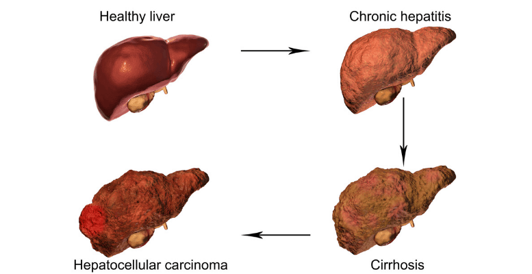 Milk Thistle And Alcohol | Healthy Liver Guide | Bobby's Fitness