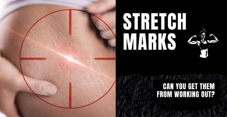 stretch marks